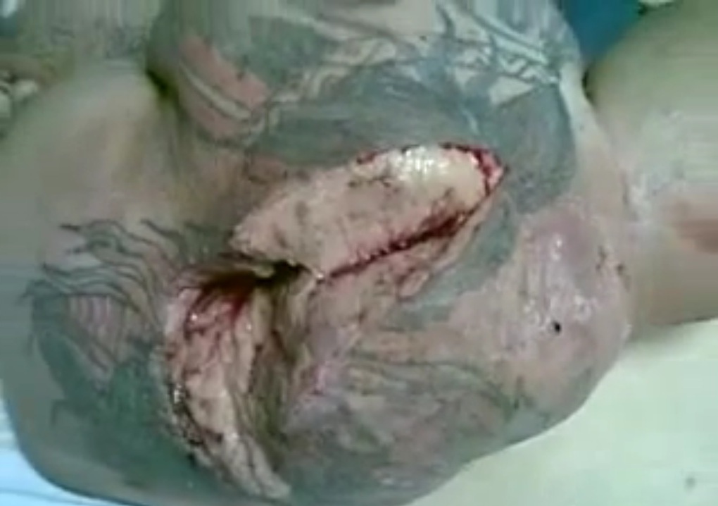 infection from injecting steroids